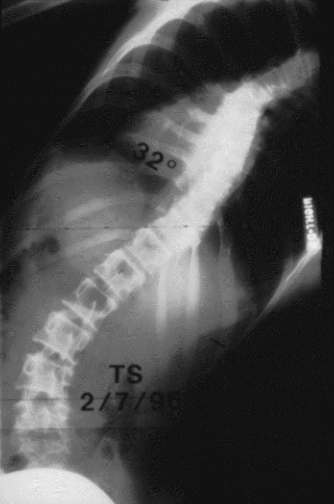 SCOLIOSI Valutazione del Paziente Radiografia durante la flessione laterale a sinistra del paziente.