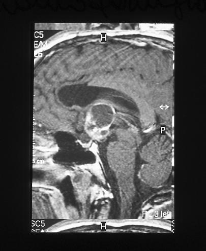 Craniofaringioma È una neoplasia che trae origine in corrispondenza della sella turcica e