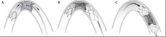 TROMBECTOMIA MECCANICA 1. Dislocazione 2. Disgregazione 3. Retrazione 4.