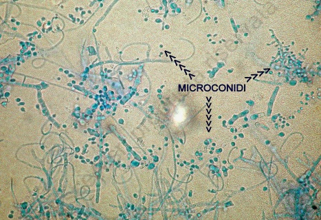 FUNGHI MICOSI CUTANEE= infezioni dello strato corneo prodotte da funghi patogeni : Dermatofiti si nutrono di cheratina e parassitano sia lo strato corneo, sia gli