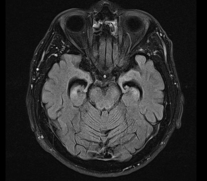 fosforilata PET-Amiloide positiva MRI: del segnale T2/Flair nei corpi mammilari e nella sostanza grigia periacqueduttale atrofia dei corpi mammilari, dell