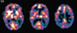 selezionati Clinica: fluttuazioni Imaging: attività nelle aree parietali e occipitali laterali Clinica: storia di ictus, segni focali MRI: patologia dei piccoli vasi o infarti strategici Clinica: