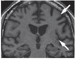 Clinica: fluttuazioni Imaging: attività nelle aree parietali e occipitali laterali PCA Clinica: alessia caratteristiche della sindrome di Balint e di Gerstmann deficit di working memory aprassia