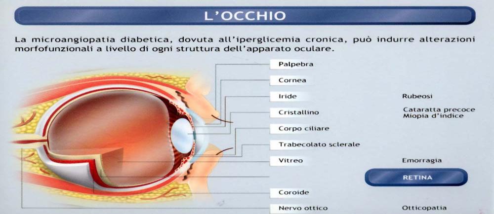 Diabete e occhio: retinopatia Comprende i danni causati dal diabete ai piccoli vasi della retina E una complicanza grave - prevalenza 20% dopo 5 anni di diabete -causa di