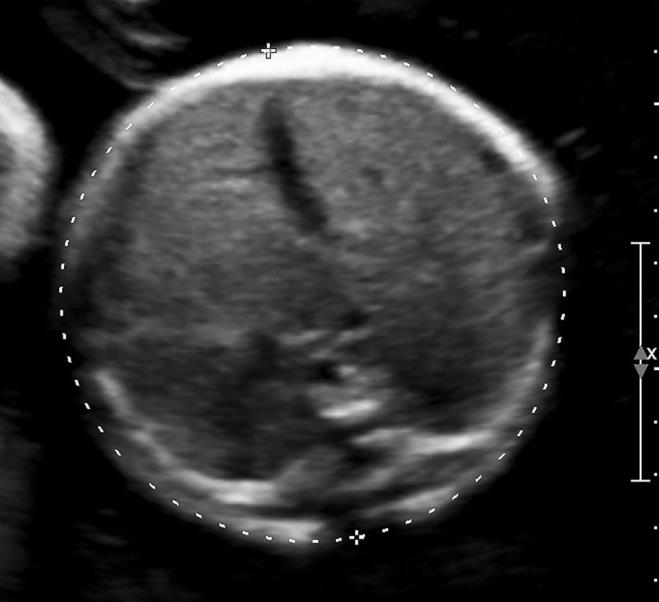 Diagnosi Diagnosi prenatale: Polidramnios (90% senza fistola, 25% se fistola) Mancata visualizzazione dello stomaco