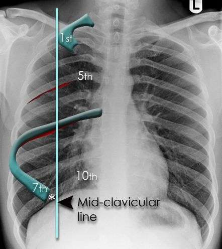 DIAFRAMMA Struttura muscolo-tendinea che separa la cavita toracica da quella addominale Nella quasi totalità dei casi si proietta all incrocio tra l