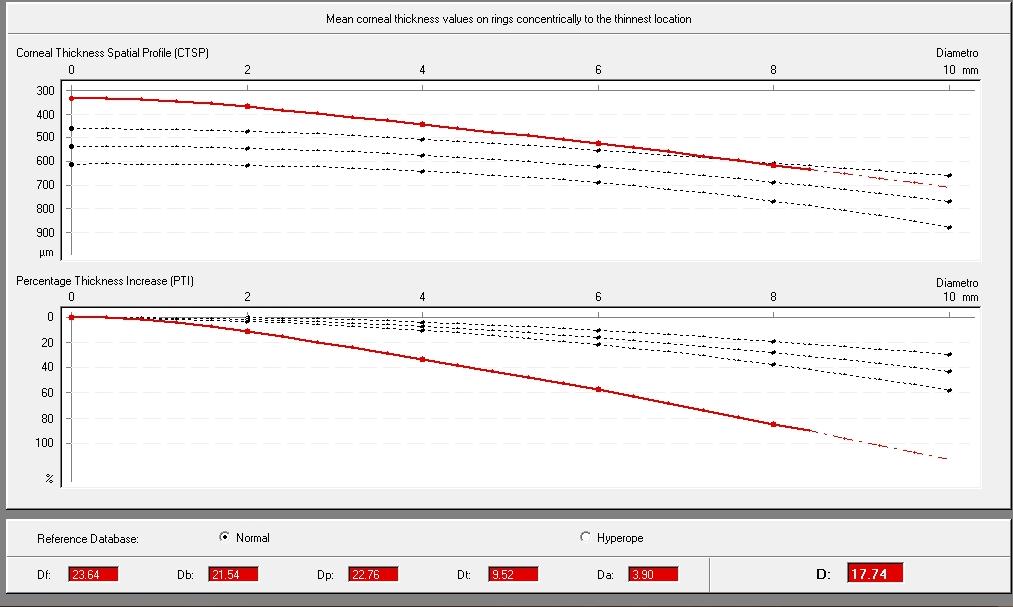 Corneal Thickness Spatial Profile sequenza di valori pachimetrici lungo 22 cerchi concentrici a diametro progressivamente maggiore, iniziando e centrati sul punto più sottile (TP) β Percentage