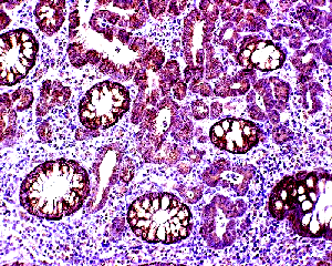 Hereditary Non-Polyposis Colorectal Cancer (HNPCC) N