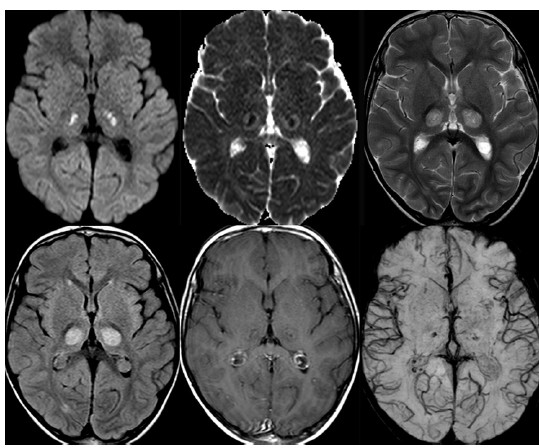 RANBP2 mut RANBP2 mut sindrome di Rett?