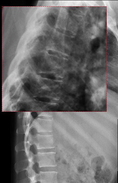 Post-operatoria: mammella