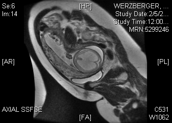 COMFORT CARE E UN TRATTAMENTO PERSONALIZZATO Fetal MRI 21 weeks OLOPROSENCEFALIA/IDROCEF ALIA SEVERA Alla nascita: respiro spontaneo e suzione, dimesso a 2 settimane di vita con