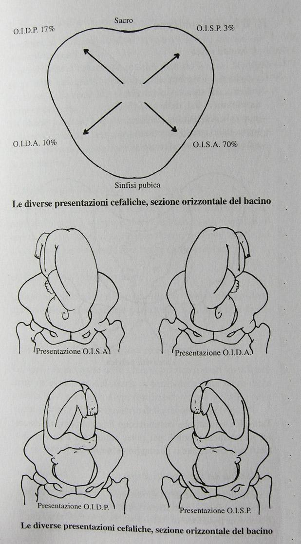 Sezione orizzontale del bacino Le diverse presentazioni cefaliche vengono denominate in base alla fetaledell