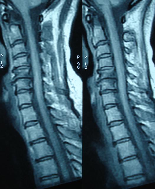 Donna a. 49 cervicobrachialgia Dx in C6.