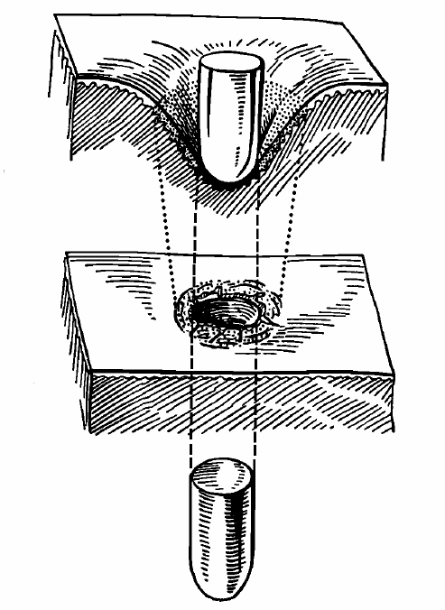 Fig. 4 (a sinistra) Foro d entrata sulla schiena del soggetto. Manca l anello di detersione perché il proiettile ha attraversato i vestiti prima d impattare sulla cute (l anello rimane sui vestiti).