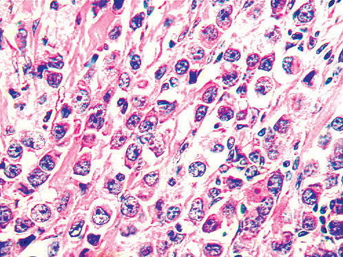Atypical Lobular Hyperplasia Lobular Carcinoma in Situ