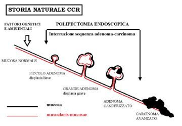 Esiste un precursore del CCR (adenoma) che è possibile diagnosticare e trattare