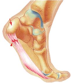 FASCITE PLANTARE La fascite plantare è l'infiammazione del tessuto fibroso nella pianta o nella parte inferiore del piede. - Dolore e rigidità nella parte inferiore del tallone.