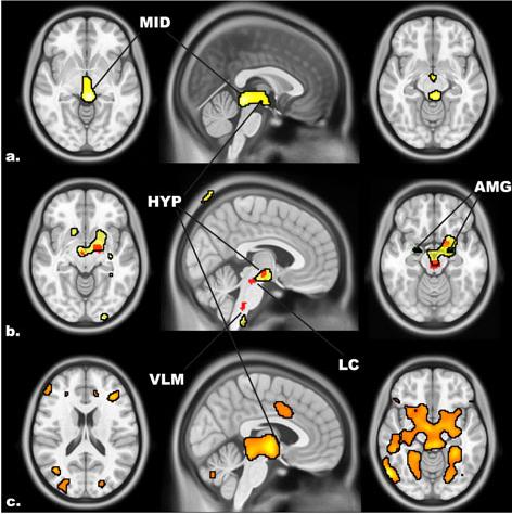 DT scores correlate with hypothalamic and midbrain areas Physical Problems (basal ganglia,