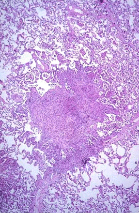 Istiocitosi X Nodular infiltrates with a stellate border extending into the surrounding interstitium in a patient with