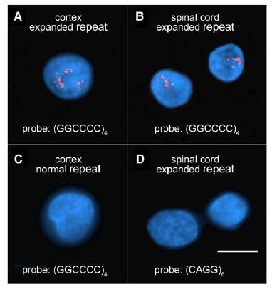 C9ORF72: foci di RNA nucleare Foci di RNA nucleare,