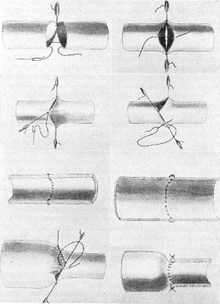 I ringraziamenti di Barnard Alexis Carrel (1873-1944) Per la tecnica delle suture vascolari End-to-end anastomosis The Carrel patch.