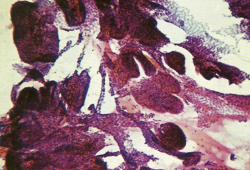Carcinoma papillare : materiale campionato ricco di frustoli, strutture papillari sovente ramificate Linee Guida ATA 2009 TIR 5 (THY5) Quadro citologico evidente di lesione maligna ( PTC, MTC,