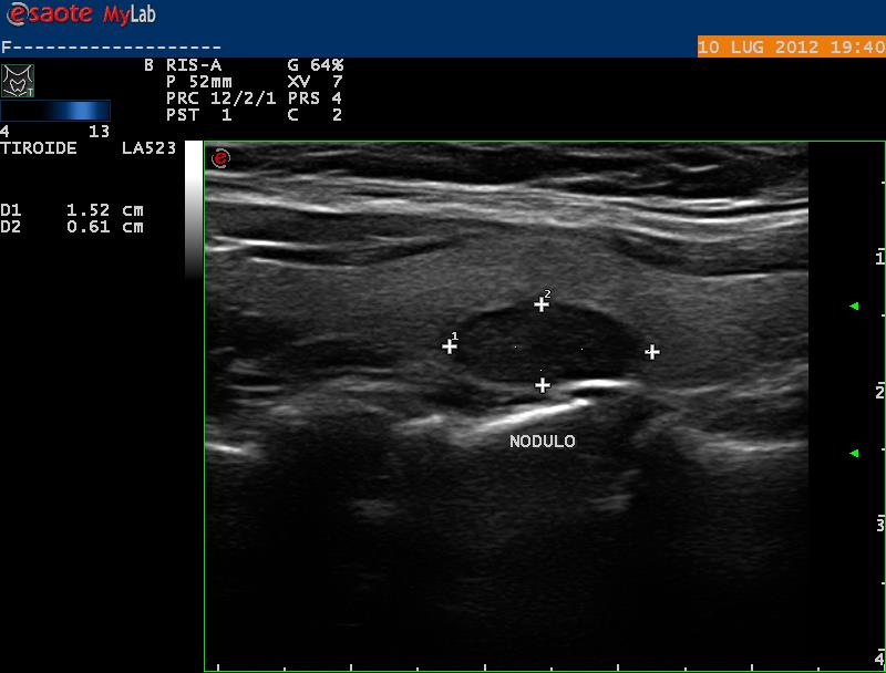 Nodulo Isoecogeno Nodulo
