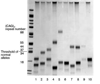 Malattia di Huntington. Amplificazione di un frammento di gene contenente ripetuti (CAG) n con la PCR e corsa su gel di polyacrylamide. Le bande sono rivelate con colorazione argentica.