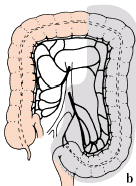 TERAPIA Tumori del trasverso distale, della flessura splenica, del discendente e del sigma: emicolectomia sinistra asportazione della metà