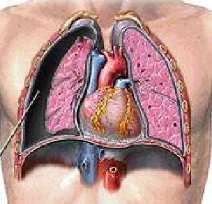 Classificazione Pnx Spontaneo EZIOLOGICA Traumatico Iatrogeno