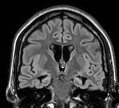 E. B. Epilessia Temporale RM: sclerosi Ippocampale bilaterale PET DFG: Ipometabolismo