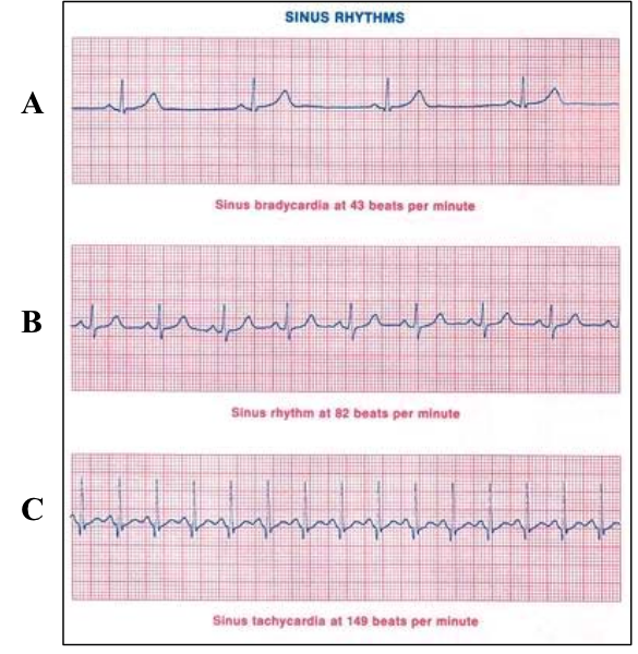 Figura 4: ECG a confronto. A. Bradicardia. B. Ritmo sinusale normofrequente. C.
