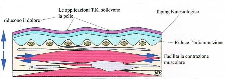 Terapia conservativa : applicazione decompressiva.