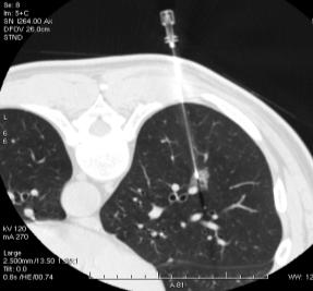 Protocollo diagnostico Nodules 5 mm Ø CT 1 year Nodules 5-8 mm Ø CT 3 months Nodules > 8 mm Ø CT/PET Procedure diagnostiche non invasive : CT/PET e