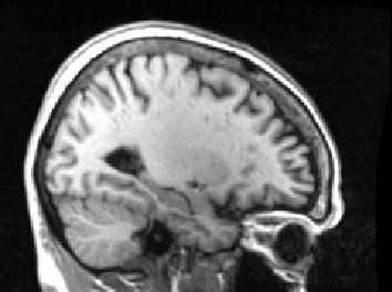 INSORGENZA DELL ALZHEIMER Analisi di neuroimmagini Attivita iniziata nel 2007 Non tutti gli MCI sviluppano l Alzheimer: analisi delle immagini di risonanza magnetica Segmentazione ed analisi della