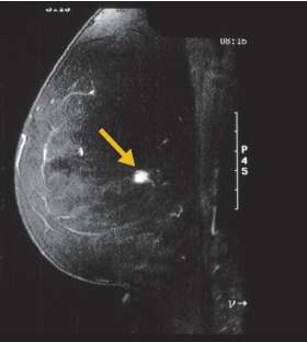 Il follow-up e l uso delle tecniche di imaging: RMN mammaria L utilità della RMN nel follow-up della paziente per lo screening della mammella Omo-controlaterale in donne con pregresso K della