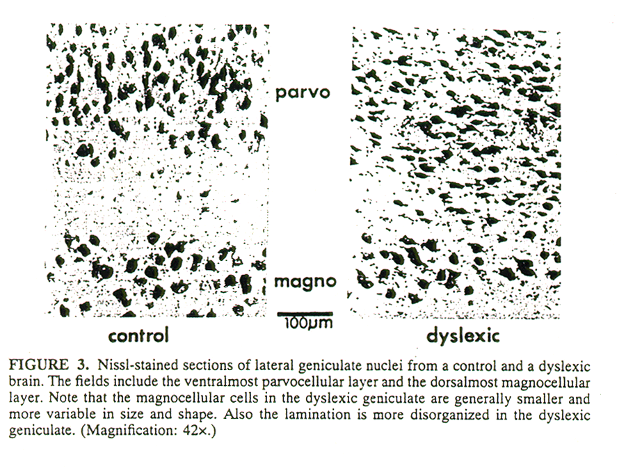 Anomalie strutturali microscopiche Nucleo genicolato laterale: Nei dislessici le cellule dello