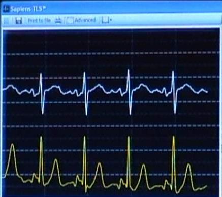 GUIDA ECG ENDOCAVITARIA Punta in profondità nell atrio dx (al di là di