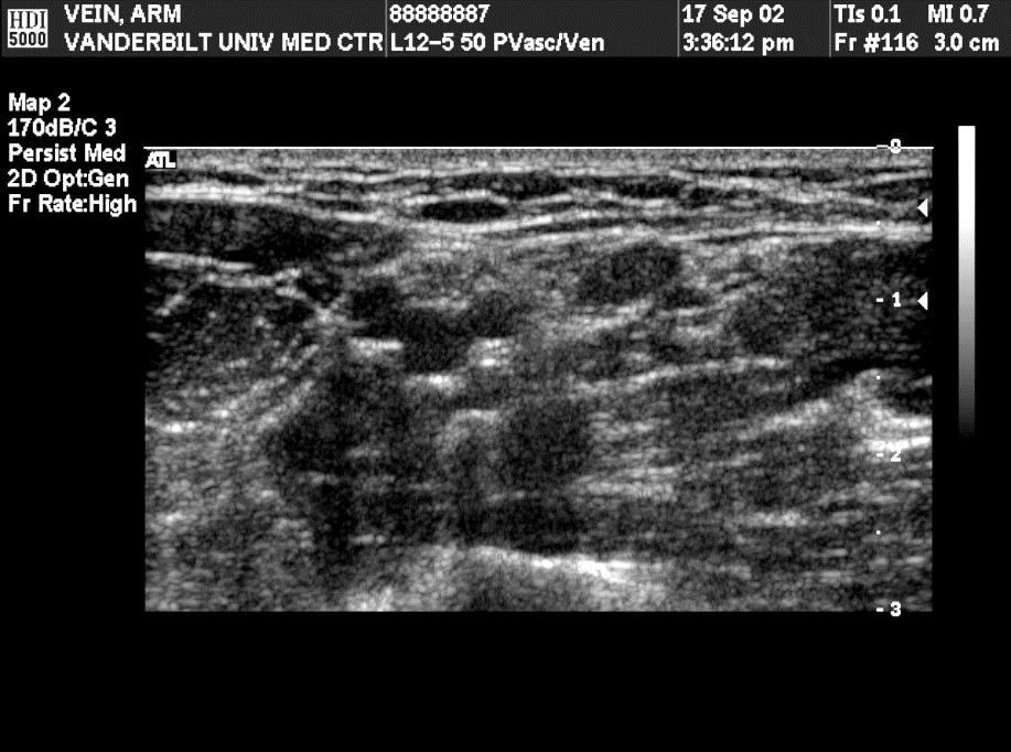 Brachial Veins