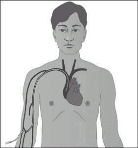 Peripherally Inserted Central Catheter (PICC) MEDIO TERMINE (1-3 mesi) Utilizzo ANCHE DISCONTINUO Utilizzo