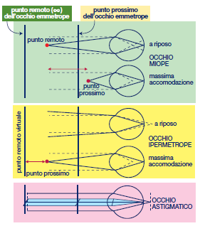 Astigmatismo: la convessità della cornea lungo i diversi assi di curvatura non è omogenea, il punto focale non è quindi univoco e darà origine ad una