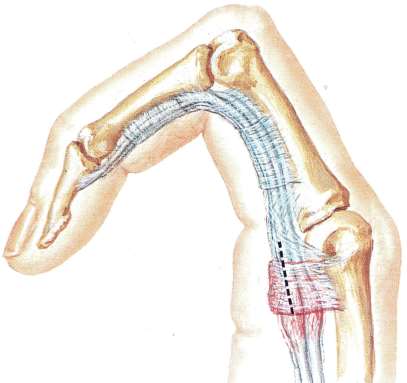 4 Malattia Notta (dito a scatto) ingrossamento infiammatorio tendini flex profondo e superficiale dito loro strozzamento da legamento anulare ispessito su