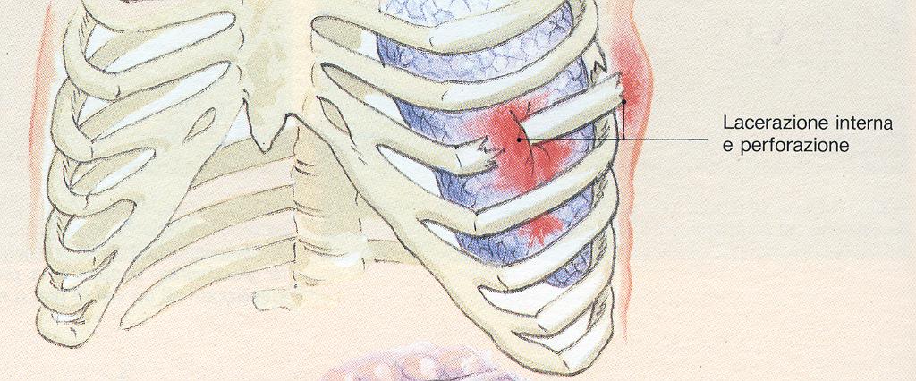 SINTOMI FRATTURA COSTOLE DOLORE AGGRAVATO DAI MOVIMENTI SHOCK DA