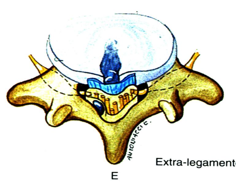 ERNIA ESPULSA