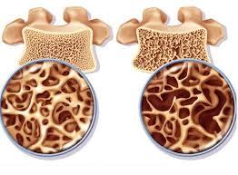 Osteoporosi Condizione patologica caratterizzata da ridotta massa ossea e