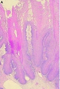 Carcinoma squamocellulare 1.