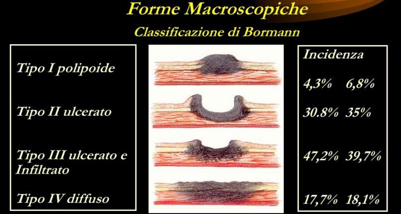 Classificazione TNM valutazione di 3 componenti: T Tumor N Nodes M Metastases - TX Tumore primitivo non definibile - T0 Tumore primitivo non evidenziabile - Tis Carcinoma in situ - tumore