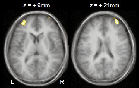 Dual Task: Middle Frontal Gyrus (BA9, BA8) and Lateral Parietal Cortex (BA40) Dual Task + Delay: Middle Frontal Gyrus