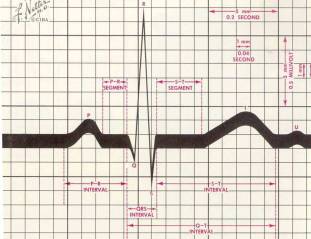 Lezione 2 Attività elettrica sopraventricolare Corso di elettrocardiografia essenziale L onda P normale Alterazioni della