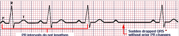 Blocchi Atrio Ventricolari TRACCIATO N 5 BAV 2 2 grado tipo I - Wencheback Progressivo allungamento del PR fino alla comparsa di onda P non